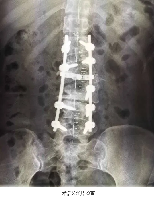 我院骨科完成新区首例先天性脊柱侧后凸畸形矫形术
